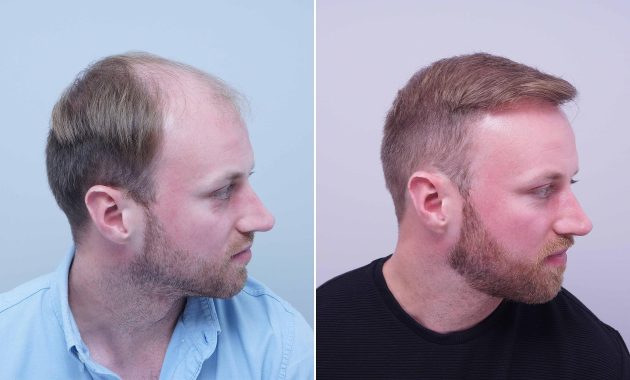 Once 40, Now 20: The Hair Transplant Transformation